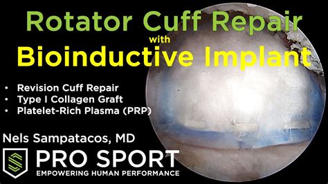 Bioinductive Collagen Implant Augmentation for the Repair of .